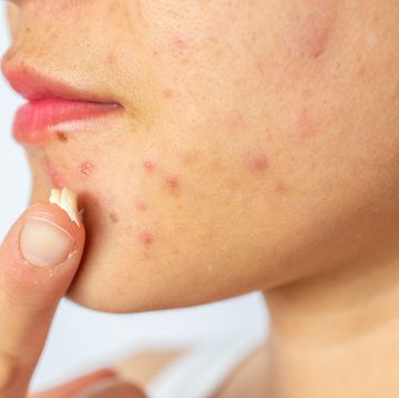 woman applying acne cream on her face for solving acne inflammation papule and pustule on her face